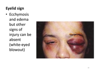 Eyelid sign
• Ecchymosis
and edema
but other
signs of
injury can be
absent
(white-eyed
blowout)
51
 
