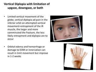 Vertical Diplopia with limitation of
upgaze, downgaze, or both
• Limited vertical movement of the
globe, vertical diplopia ad pain in the
inferior orbit on attempted vertical
movement=entrapment of the IR
muscle, the larger and more
comminuted the fracture, the less
likely entrapment and diplopia are to
occur
• Orbital edema and hemorrhage or
damage to EOM or innervation can
result in limit movement but improve
in 1-2 weeks
52
 