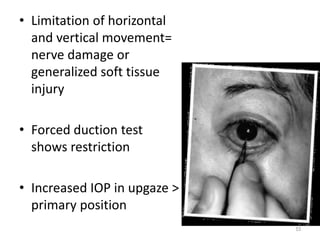 • Limitation of horizontal
and vertical movement=
nerve damage or
generalized soft tissue
injury
• Forced duction test
shows restriction
• Increased IOP in upgaze >
primary position
53
 