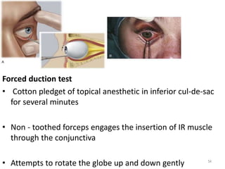 Forced duction test
• Cotton pledget of topical anesthetic in inferior cul-de-sac
for several minutes
• Non - toothed forceps engages the insertion of IR muscle
through the conjunctiva
• Attempts to rotate the globe up and down gently 54
 