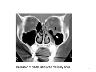60
Herniation of orbital fat into the maxillary sinus
 