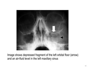 61
Image shows depressed fragment of the left orbital floor (arrow)
and an air-fluid level in the left maxillary sinus
 