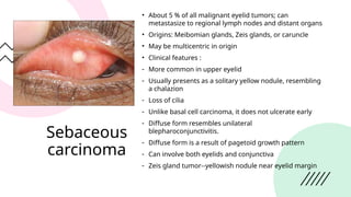 Malignant tumors of anterior segment of eye .pptx