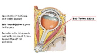 Tenon Injection Orbit Anatomy and Surgical Spaces | PPTX