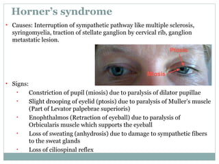 Orbit and Extra-Ocular Muscles | PPT