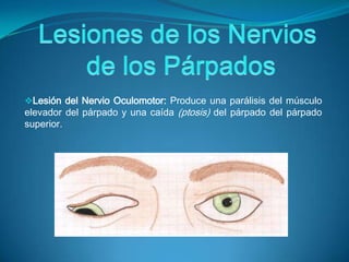 Pérdida de tono muscular en el párpado inferior- produce eversión y sequedad corneal, deja al ojo sin protección contra el polvo y las partículas pequeñas.