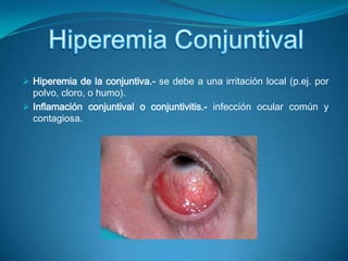 Obstrucción de una glándula tarsal.- produce una inflamación, un chalazión tarsal ,que protruye hacia el ojo y se comprime contra él cuando se cierran los párpados.Hiperemia ConjuntivalHiperemia de la conjuntiva.- se debe a una irritación local(p.ej. por polvo, cloro, o humo).