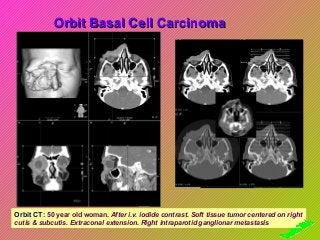 Orbit Basal Cell Carcinoma

Orbit CT: 50 year old woman. After i.v. iodide contrast. Soft tissue tumor centered on right
cutis & subcutis. Extraconal extension. Right intraparotid ganglionar metastasis

 