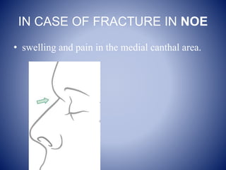 IN CASE OF FRACTURE IN NOE
• swelling and pain in the medial canthal area.
 