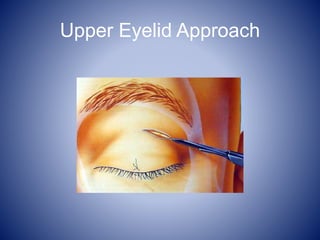 Upper Eyelid Approach
 