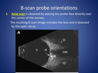 B-scan probe orientations
1. Axial scan is obtained by placing the probe face directly over
the center of the cornea.
The resulting B-scan image includes the lens and is bisected
by the optic nerve.
 