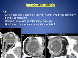 Imaging protocols
CT
• Axial + coronal planes; thin-sections (~ 2 mm),Multislice acquisition
• Soft tissue algorithm
• Contrast for masses or inflammatory disease
• Noncontrast only when in conjunction with MR
 