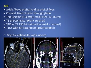 MR
• Axial: Above orbital roof to orbital floor
• Coronal: Back of pons through globe
• Thin-section (3-4 mm); small FOV (12-16 cm)
• T1 pre-contrast (axial + coronal)
• STIR or T2 FSE fat-saturation (axial + coronal)
• T1C+ with fat-saturation (axial+coronal)
• Sagittal oblique for optic nerves
 