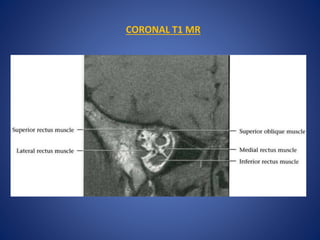 CORONAL T1 MR
 
