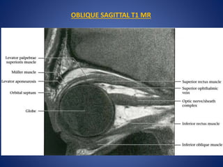 OBLIQUE SAGITTAL T1 MR
 