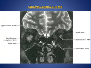 CORONAL &AXIAL STIR MR
 