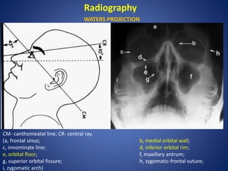 Radiography
WATERS PROJECTION
CM- canthomeatal line; CR- central ray.
(a, frontal sinus; b, medial orbital wall;
c, innominate line; d, inferior orbital rim;
e, orbital floor; f, maxillary antrum;
g, superior orbital fissure; h, zygomatic-frontal suture;
i, zygomatic arch)
 
