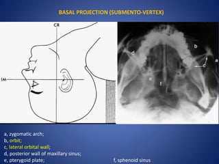 BASAL PROJECTION (SUBMENTO-VERTEX)
a, zygomatic arch;
b, orbit;
c, lateral orbital wall;
d, posterior wall of maxillary sinus;
e, pterygoid plate; f, sphenoid sinus
 