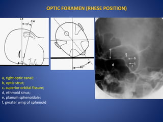 OPTIC FORAMEN (RHESE POSITION)
a, right optic canal;
b, optic strut;
c, superior orbital fissure;
d, ethmoid sinus;
e, planum sphenoidale;
f, greater wing of sphenoid
 
