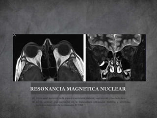 RESONANCIA MAGNETICA NUCLEAR
A) Corte axial: aumento de la grasa intraorbitaria bilateral, +extraconal y mas lado dere
B) Corte coronal: engrosamiento de la musculatura extraocular bilateral y simetrica,
fundamentalmente de los musculos RI Y RM.
 