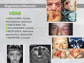 Diagnóstico Diferencial
VASCULARES: Fistula,
hemangioma cavernoso
ENDOCRINA: OD
INFLAMATORIA: celulitis
NEOPLASICA: Adenoma
pleomorfico, Glioma NO.
SINDROME: Crouzon
 
