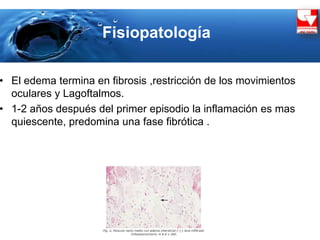 Fisiopatología
• El edema termina en fibrosis ,restricción de los movimientos
oculares y Lagoftalmos.
• 1-2 años después del primer episodio la inflamación es mas
quiescente, predomina una fase fibrótica .
 