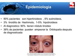 Epidemiologia
• 90% pacientes son hipertiroideos , 6% eutiroideos,
• 3% tiroiditis de Hashimoto, 1-5% hipotiroideos
• Al diagnostico: 90% tienen nódulo tiroideo
• 36% de pacientes pueden empeorar la Orbitopatía después
de diagnosticada
 