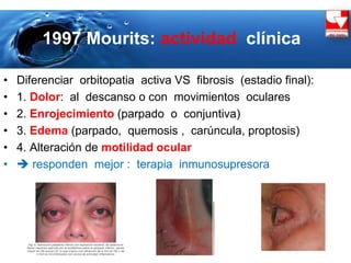 1997 Mourits: actividad clínica
• Diferenciar orbitopatia activa VS fibrosis (estadio final):
• 1. Dolor: al descanso o con movimientos oculares
• 2. Enrojecimiento (parpado o conjuntiva)
• 3. Edema (parpado, quemosis , carúncula, proptosis)
• 4. Alteración de motilidad ocular
•  responden mejor : terapia inmunosupresora
 