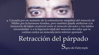  Causada por un aumento de la estimulación simpática del músculo de
Müller por la hormona tiroidea, pero también puede atribuirse a la
formación de tejido cicatricial entre el músculo elevador y los tejidos
circundantes o a la hiperactividad del músculo elevador que se
contrae contra un músculo recto inferior apretado
Retracción del párpado
Signo de Dalrymple
 
