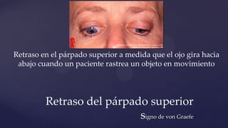 Retraso en el párpado superior a medida que el ojo gira hacia
abajo cuando un paciente rastrea un objeto en movimiento
Retraso del párpado superior
signo de von Graefe
 