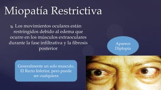 Los movimientos oculares están
restringidos debido al edema que
ocurre en los músculos extraoculares
durante la fase infiltrativa y la fibrosis
posterior
Miopatía Restrictiva
Aparece
Diplopía
Generalmente un solo musculo,
El Recto Inferior, pero puede
ser cualquiera
 