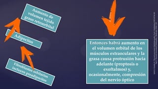 Entonces habrá aumento en
el volumen orbital de los
músculos extraoculares y la
grasa causa protrusión hacia
adelante (proptosis o
exoftalmos) y,
ocasionalmente, compresión
del nervio óptico
ŞahlıE,GündüzK.Thyroid-associatedOphthalmopathy.TurkJOphthalmol2017;47:94-105
IngE.Thyroid-AssociatedOrbitopathy.Medscape,2016:120
 
