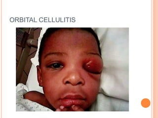 ORBITAL CELLULITIS
 