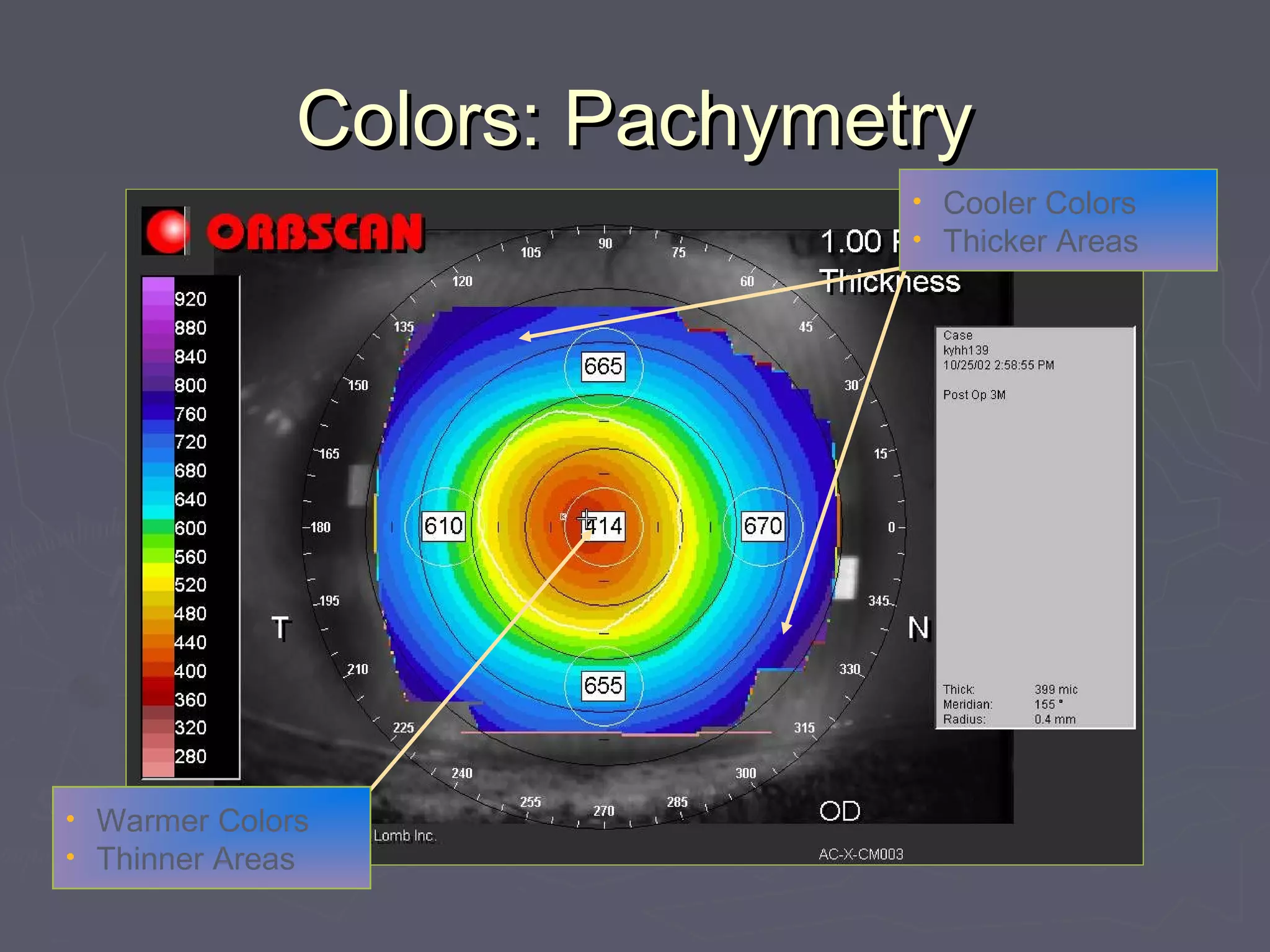 Colors: PachymetryColors: Pachymetry
• Cooler Colors
• Thicker Areas
• Warmer Colors
• Thinner Areas
 