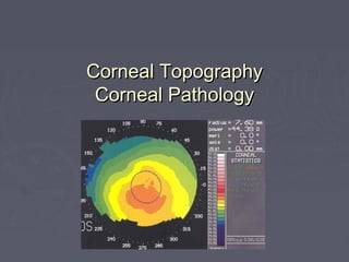 Corneal TopographyCorneal Topography
Corneal PathologyCorneal Pathology
 