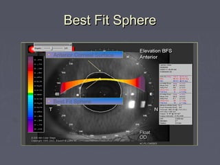 Best Fit SphereBest Fit Sphere
• Anterior Corneal Surface
• Best Fit Sphere
 