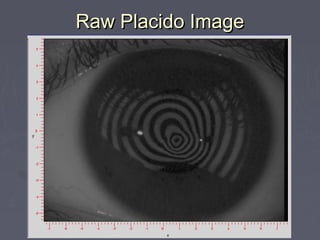Raw Placido ImageRaw Placido Image
 