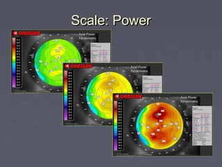 Scale: PowerScale: Power
1.0 D
0.5 D
.25 D
 