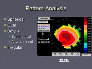20.8%17.5%32.1%7.1%22.6%
Pattern AnalysisPattern Analysis
►SphericalSpherical
►OvalOval
►BowtieBowtie
 SymmetricalSymmetrical
 AsymmetricalAsymmetrical
►IrregularIrregular
 
