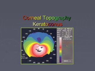 CoCornrnealeal ToTopopogrgrapaphyhy
KeKerratatoococonnusus
 