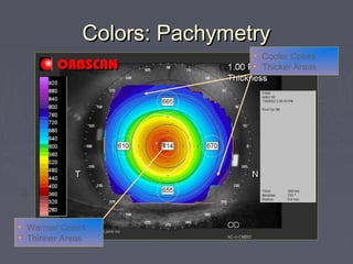 Colors: PachymetryColors: Pachymetry
• Cooler Colors
• Thicker Areas
• Warmer Colors
• Thinner Areas
 
