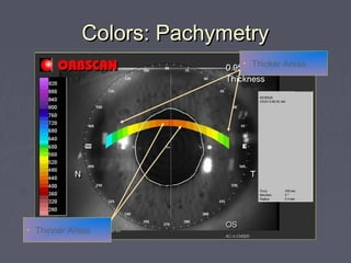 Colors: PachymetryColors: Pachymetry
• Thicker Areas
• Thinner Areas
 