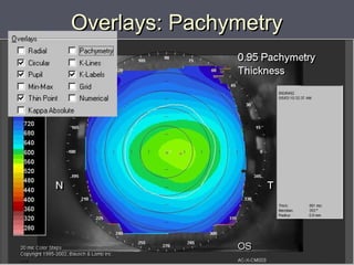 Overlays: PachymetryOverlays: Pachymetry
 