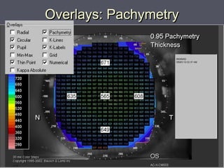 Overlays: PachymetryOverlays: Pachymetry
 