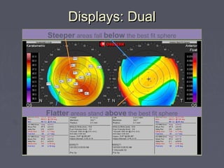 Displays: DualDisplays: Dual
Axial Power Map Anterior Elevation
Flatter areas stand above the best fit sphere
Steeper areas fall below the best fit sphere
 