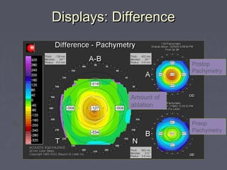 Displays: DifferenceDisplays: Difference
Preop
Pachymetry
Postop
Pachymetry
Amount of
ablation
 
