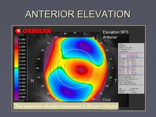 ANTERIOR ELEVATIONANTERIOR ELEVATION
The maximum elevation measured is 65 µm (>55µm)
 