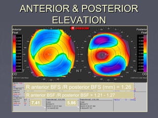 ANTERIOR & POSTERIORANTERIOR & POSTERIOR
ELEVATIONELEVATION
R anterior BSF /R posterior BSF > 1.21 - 1.27
R anterior BFS /R posterior BFS (mm) = 1.26
7.41 5.86
 