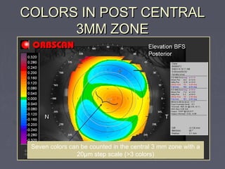 COLORS IN POST CENTRALCOLORS IN POST CENTRAL
3MM ZONE3MM ZONE
Seven colors can be counted in the central 3 mm zone with a
20µm step scale (>3 colors)
 