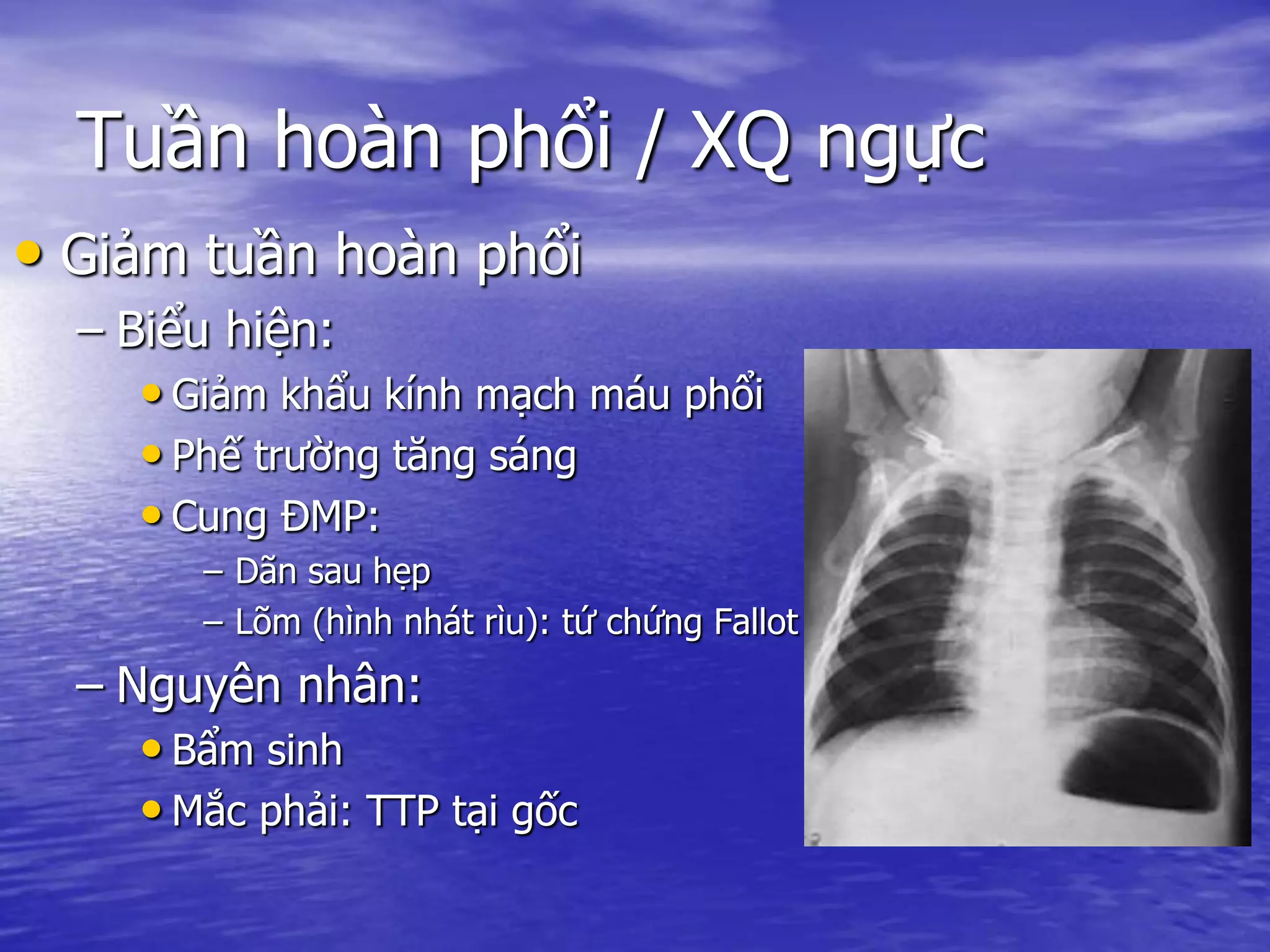 Tuần hoàn phổi / XQ ngực
• Giảm tuần hoàn phổi
– Biểu hiện:
• Giảm khẩu kính mạch máu phổi
• Phế trường tăng sáng
• Cung ĐMP:
– Dãn sau hẹp
– Lõm (hình nhát rìu): tứ chứng Fallot
– Nguyên nhân:
• Bẩm sinh
• Mắc phải: TTP tại gốc
 